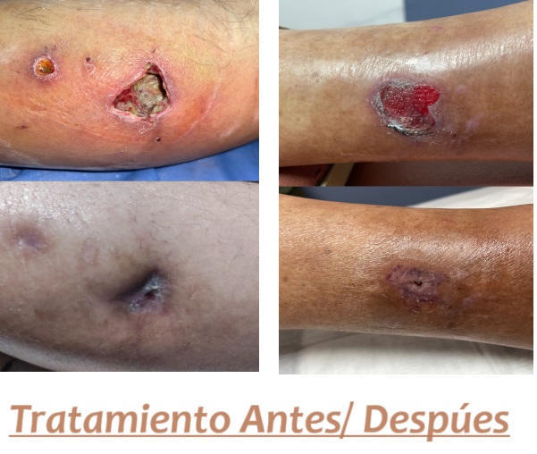 tratamiento para pie diabético