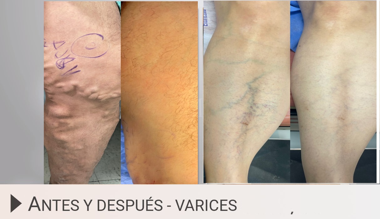 tratamiento para varices